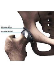 Hip Resurfacing - Orthopaedic Surgery India
