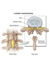 Laminectomy - Orthopaedic Surgery India