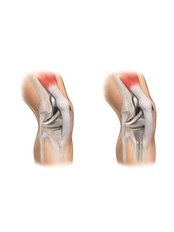 Knee Replacement - Orthopaedic Surgery India