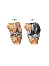 Joint Replacement Surgery - Orthopaedic Surgery India