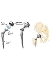 Hip Replacement - Orthopaedic Surgery India