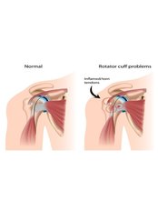 Rotator Cuff Repair - Orthopaedic Surgery India