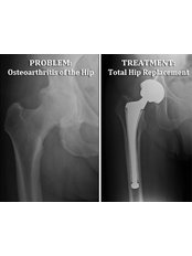 Hip Replacement - Shree Meenakshi Orthopedics & Sports Medicine