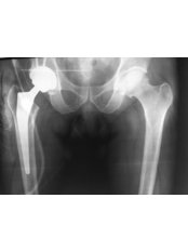 Hip Replacement - Joint Replacement Clinic