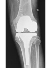 Joint Replacement Surgery - Joint Replacement Clinic
