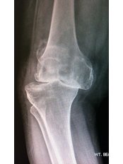 Knee Replacement - Joint Replacement Clinic
