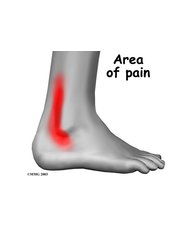 Ankle Injury Treatment - The Interventional Pain & Ozone Clinic