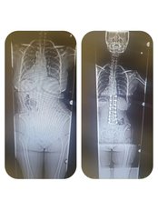Scoliosis Surgery - Health & More