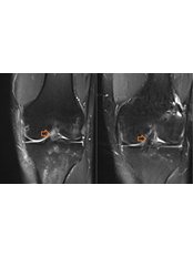 Anterior Cruciate Ligament (ACL) Reconstruction - Dr Gemalmaz - 3D Patient-Specific Orthopedics
