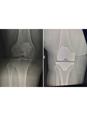 Total Knee Replacement (Arthroplasty) - Dr Gemalmaz - 3D Patient-Specific Orthopedics