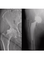 Total Hip Replacement (Arthroplasty) - Dr Gemalmaz - 3D Patient-Specific Orthopedics