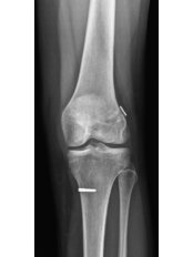 Anterior Cruciate Ligament Reconstruction - Knee Ligament Reconstruction - Caria Orthopaedics & Rehabilitation