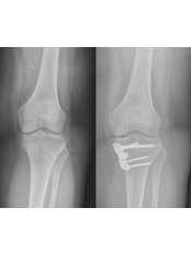 Osteotomy - Caria Orthopaedics & Rehabilitation