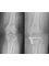 Caria Orthopaedics & Rehabilitation - High Tibial Osteotomy 