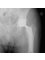 Caria Orthopaedics & Rehabilitation - Total Hip Replacement 