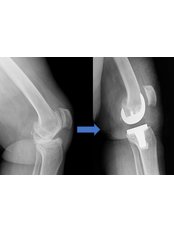 Knee Arthroplasty - Caria Orthopaedics & Rehabilitation