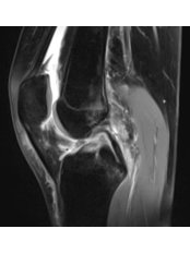 Anterior Cruciate Ligament Reconstruction - Knee Ligament Reconstruction - Caria Orthopaedics & Rehabilitation