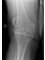Salford Hip & Knee Clinic - Pre-op left knee 