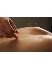 Acupuncture Treatment - Clinic 8 - St. Albans