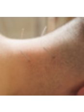 Dry Needling - APRC Physiotherapy Greater Noida
