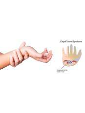 Carpal Tunnel Syndrome - GEOS Physio Rehab Klang