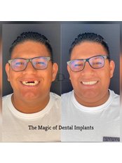 The Dental Central - Dental implants.