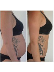 I-Lipo Lazer Centre - Client after 6 weeks