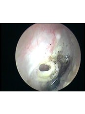 ENT, Head, Neck clinic and hearing aid centre - ear drum perforation with fungal infection