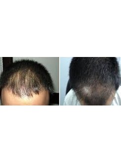 Hair Transplant in Ambala City, India • Check Prices & Reviews
