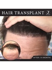 June clinic - Hair Loss Clinic in Thailand