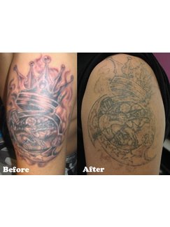 Tattoo Removal in Central And Western, Hong Kong SAR • Check Prices &  Reviews