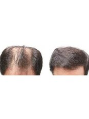 Delhi Hair Clinic - Jalandhar - Hair Loss Clinic in India