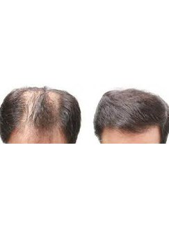 Hair Transplant in Jalandhar, India • Check Prices & Reviews