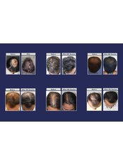 The Esthetic Clinics - before after pictures of QR678 hair regrowth treatment 