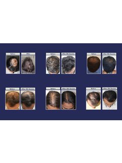 Hair Loss Treatment in Mumbai, India • Check Prices & Reviews
