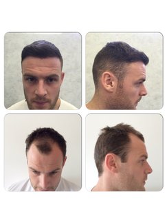 Hair Transplant in Kent • Check Prices & Reviews