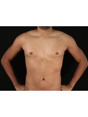 Breast Body Clinic - Before HD Liposuction