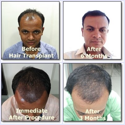 Dev Hair Transplant Clinic in Ahmedabad, India