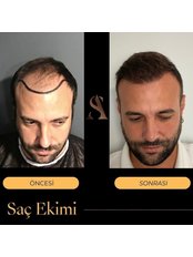 Dr. Ali Şahan Hairclinic - Hair Loss Clinic in Turkey