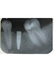 32 smiles. your gum care and beyond...!!! - dental Implant