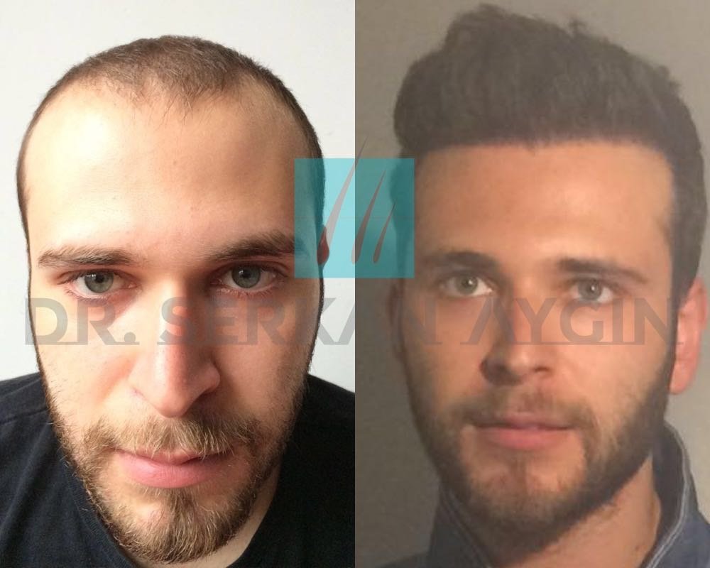 Сколько стоит пересадка бороды. Трансплантация волос на бороду. Борода после пересадки. До и после пересадки волос.