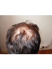pestanas - Hair Loss Clinic in the UK