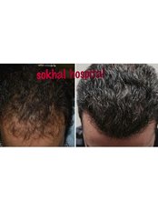 Sokahl Hospital - Hair Loss Clinic in India
