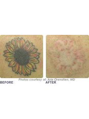 Cannelle Beauty - Oxford - tattoo removal