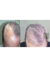 Nour Clinic - Pre and Post Hair transplant - FUE for treatment of scalp scar 
