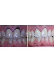 Fairies Cross Dental Clinic - Crowns Before and After
