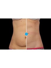 Bristol Fat Freeze - Medical Aesthetics Clinic in the UK