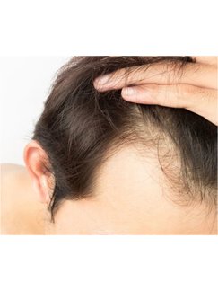 Biofibre® Hair Implant in Europe • Check Prices & Reviews