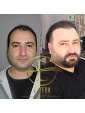 Esteda Hair Transplant Hospital - Hair Loss Clinic in Turkey