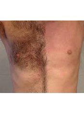 Skin, Body and Beauty Improvements Clinic - Permanent painless hair removal on all colour types